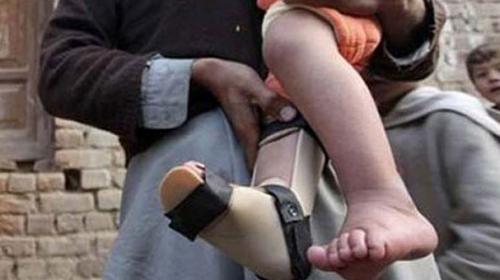 No new polio cases in Syria reported for a year: WHO