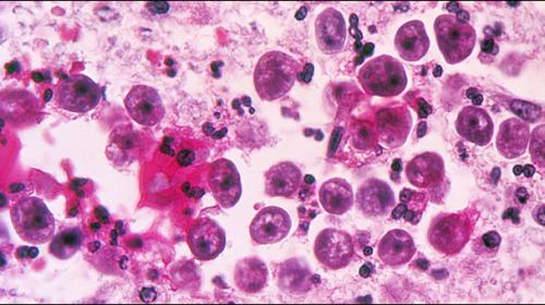 Naegleria claims one more life in Sindh 