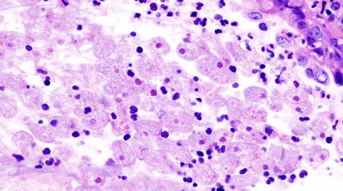 Naegleria claims year’s first victim in Karachi