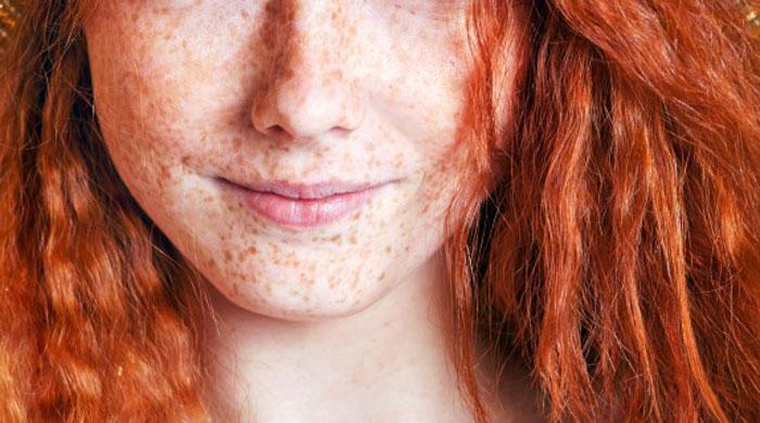 Skin cancer risk for freckly red-heads same as 21 years in sun