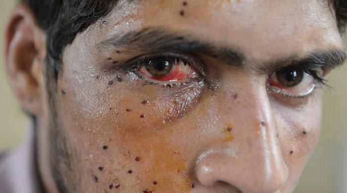 Pakistan offers medical treatment to victims of state violence in Kashmir