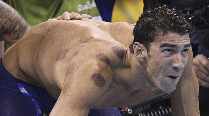 Olympians use ancient Hijama therapy to cure body pain