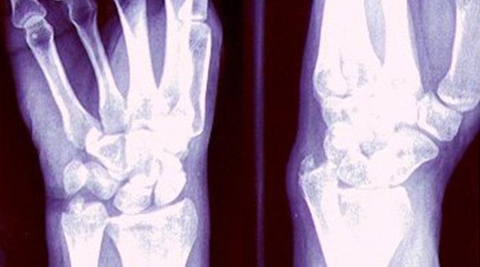 After a fracture, patients often continue meds that boost fracture risk