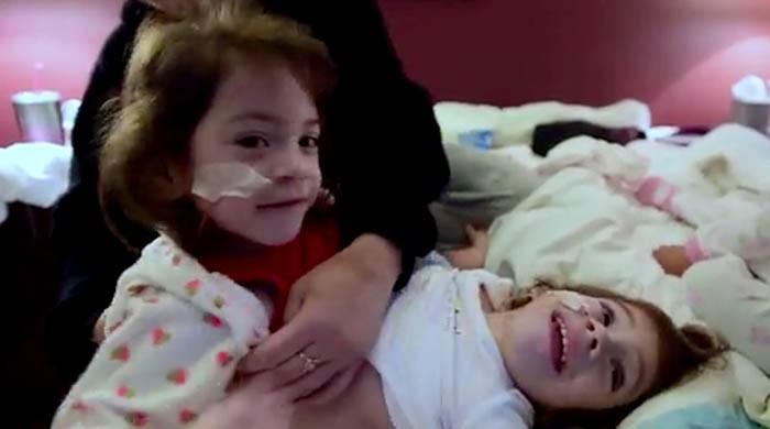 Conjoined twins who faced each other separated in California surgery