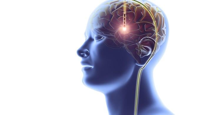 Scientists test deep brain stimulation as potential anorexia therapy