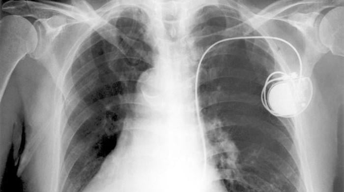 Pacemakers may malfunction near certain appliances or tools