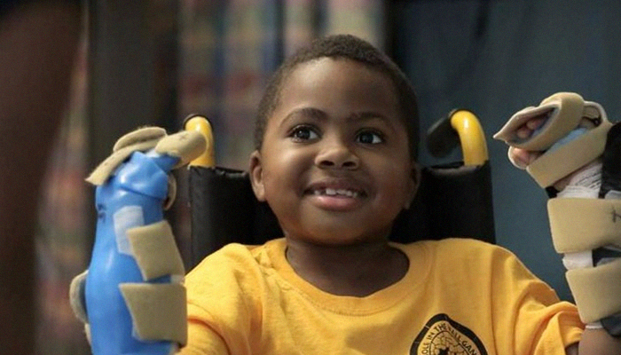 World's first child hand transplant a 'success'