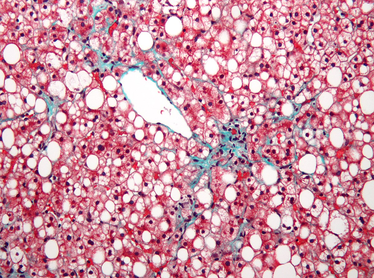 Fatty liver linked to a shrinking brain Fatty liver linked to a shrinking brain