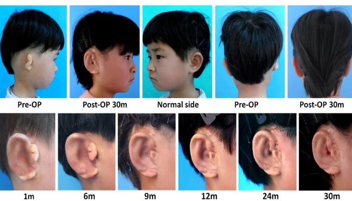 Scientists grow new ears for children born with defected or no organ