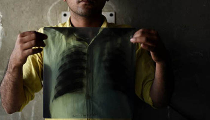 Over 27,000 new cases of TB emerge in Balochistan every year: report