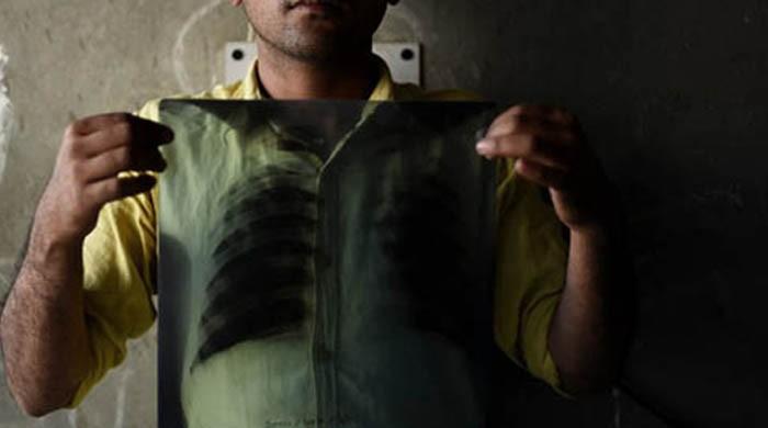Over 27,000 new cases of TB emerge in Balochistan every year: report