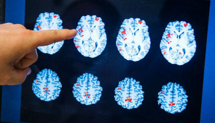 Head injury boosts dementia risk: study