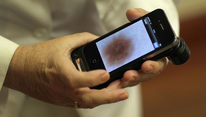 AI better at finding skin cancer than doctors: study