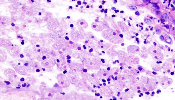 Naegleria claims another life in Karachi
