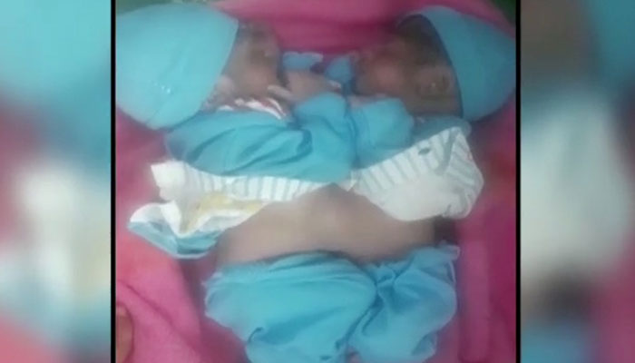 Conjoined twins born at Okara hospital 