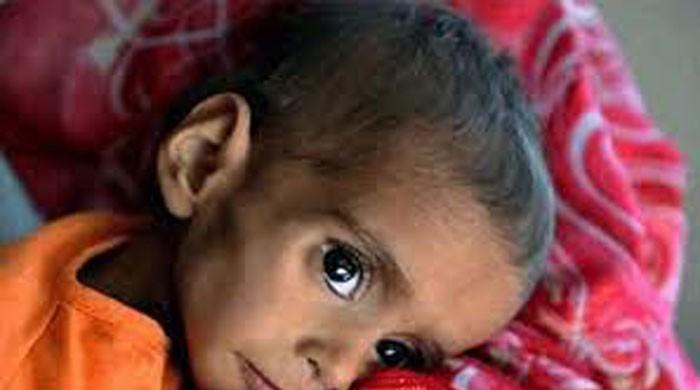 Two minors succumb to malnutrition in Mithi  Two minors succumb to malnutrition in Mithi