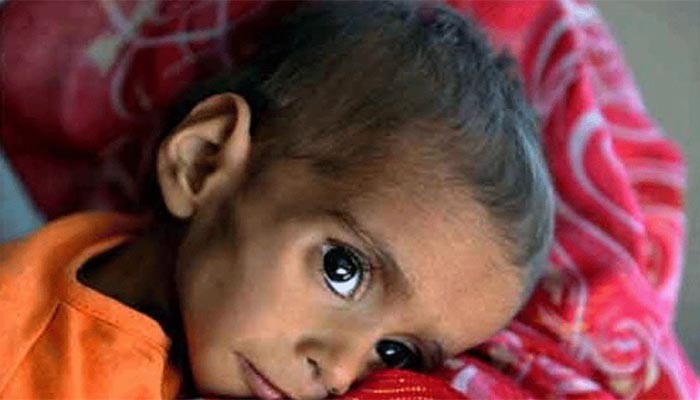 Death toll in Tharparkar rises as four more minors die due to malnutrition