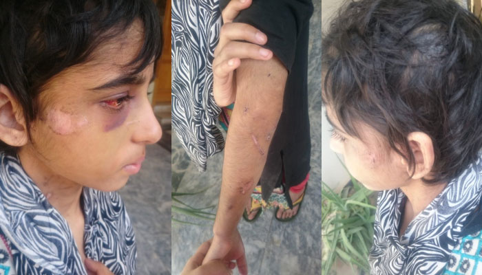 11-year-old domestic worker subjected to brutal torture in Rawalpindi