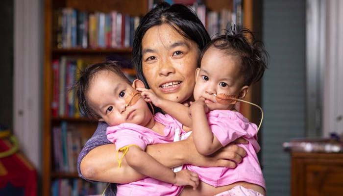 Conjoined Bhutanese twins separated in Australia surgery