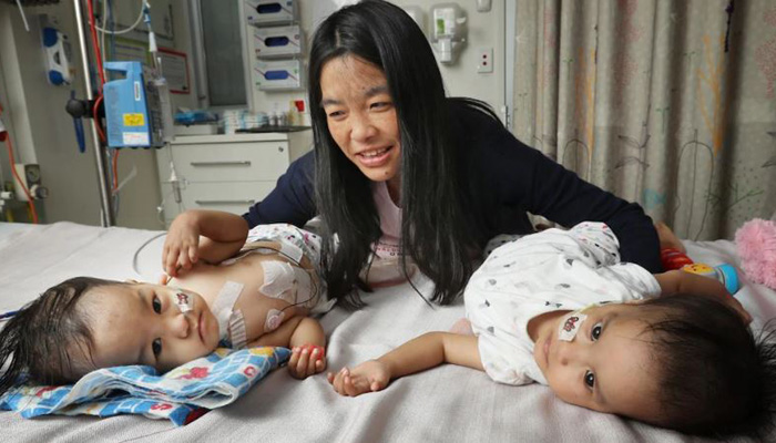 Separated Bhutanese twins leave Australia hospital