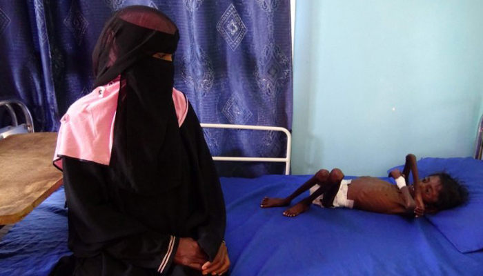 Yemen hospital struggles with number of malnourished children