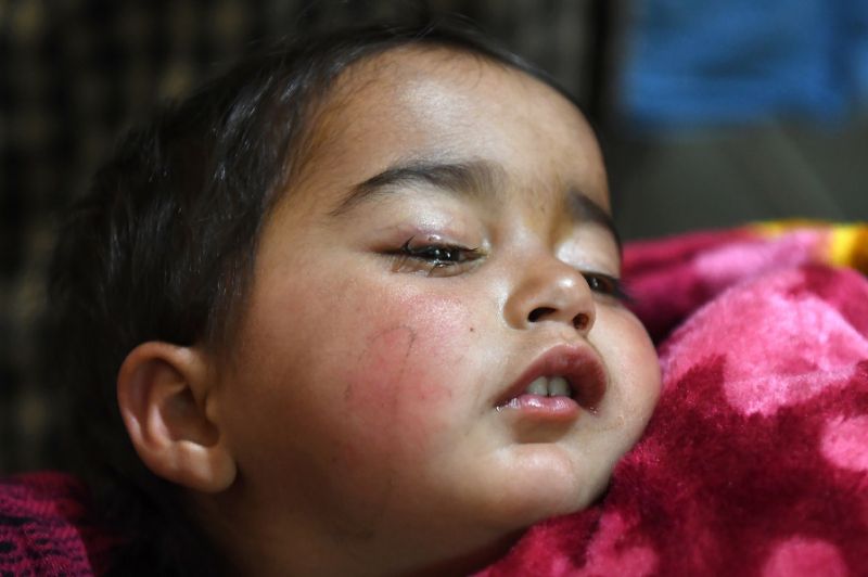 Doctors operate on child whose shooting in eye sparked anger in Occupied Kashmir 