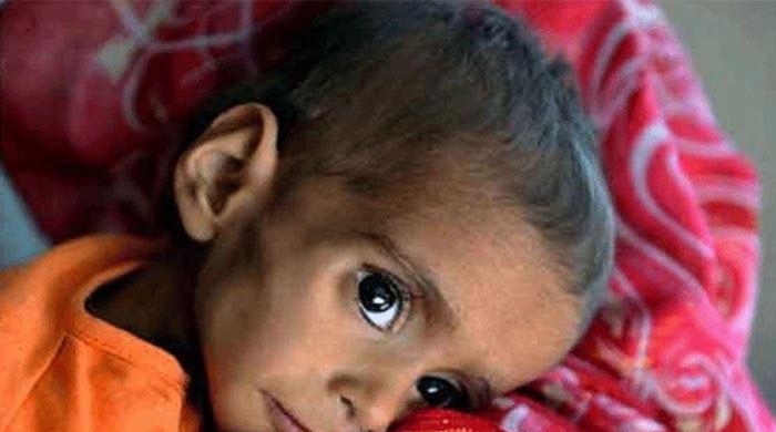 Malnutrition takes 10 more lives in Thar Malnutrition takes 10 more lives in Thar
