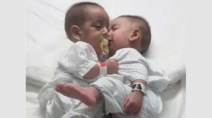 Ten-month-old conjoined twins separated after successful surgery at Karachi hospital