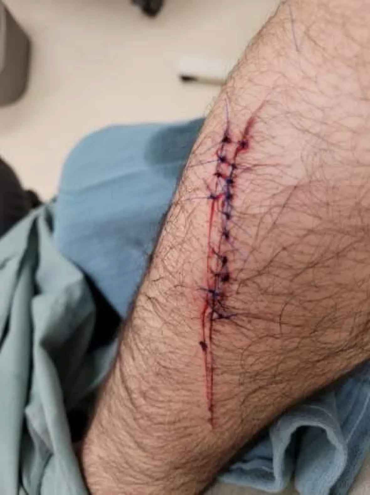 Muhammad Kashif needed 14 stitches to close a wound on his arm after an attack Friday morning in Saskatoon, Canada. — Photo courtesy CBC/Muhammad Kashif