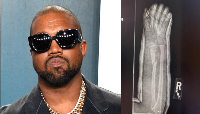 Kanye West shares snaps of what looks like son Saints broken arm