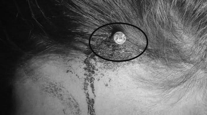 Peshawar: Following instructions of fake aamil, pregnant woman hammers nail into her head 