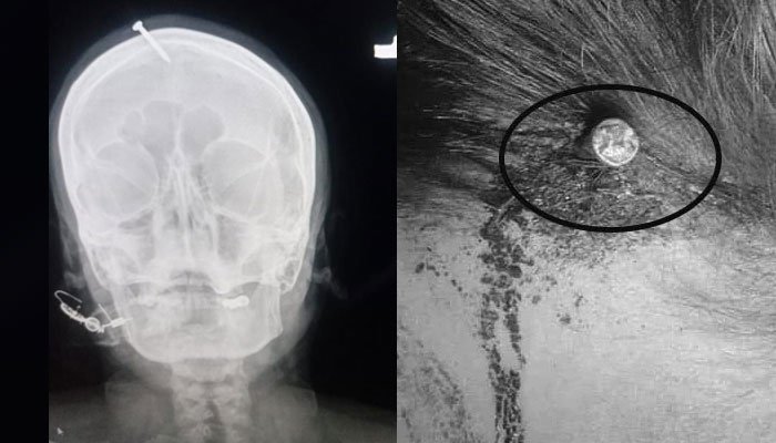 image showing x-ray report of woman who hammered nail on her head — Screengrab via Geo News