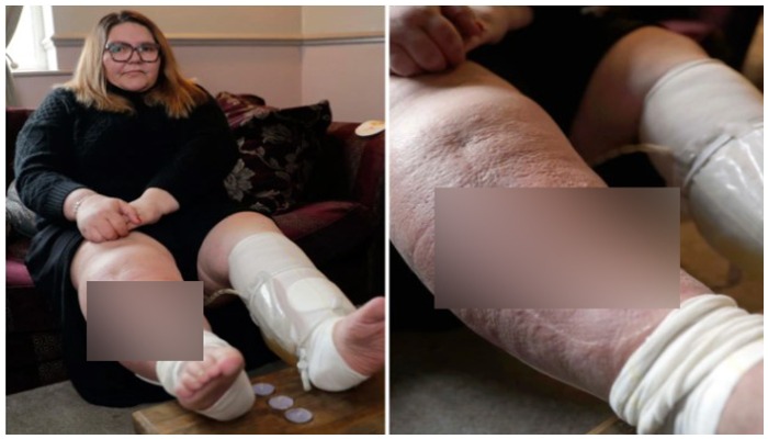 Fern Wolmald, 48, was bitten by a mysterious insect back in 2017 but her legs are still infected and swollen to date. — Men Media via The Mirror.