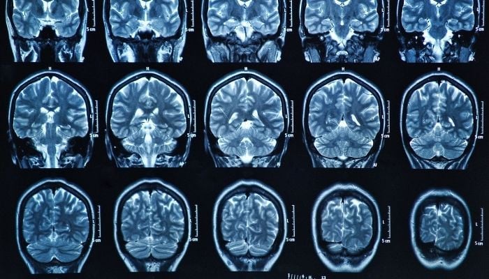 Pemindaian otak pasca COVID mengungkapkan penyusutan: studi