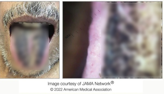 Man develops shockingly common disease, grows hair on tongue - Geo News