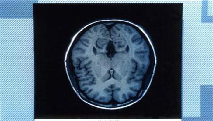 An MRI brain scan in an undated image. Scans have shown near-normal brain activity in a second patient who is in a vegetative state, British researchers reported on Monday in a study that may show a way to predict who is likely to recover from the usually hopeless condition. — Reuters/NIH/Handout