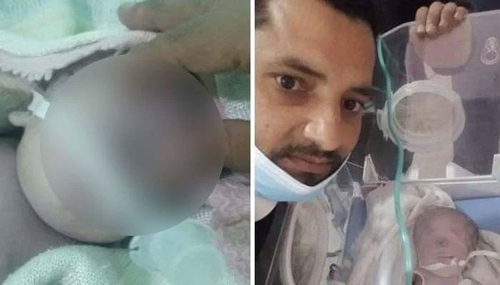 One-eyed baby dies seven hours after its birth. — Gulf News