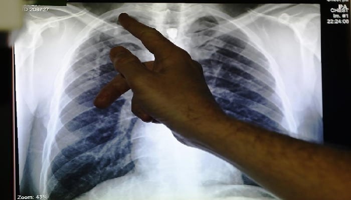 Clinical lead Doctor Al Story points to an x-ray showing a pair of lungs infected with TB (tuberculosis) during an interview with Reuters on board the mobile X-ray unit screening for TB in Ladbroke Grove in London January 27, 2014. —Reuters