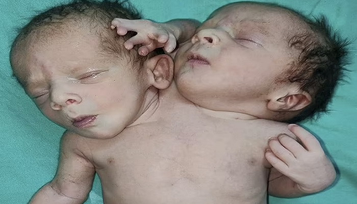 Bayi lahir dengan dua kepala dan tiga tangan, dokter tertegun