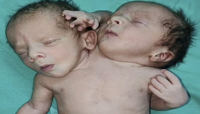 Conjoined twins were born on March 28 in Ratlam, Madhya Pradesh, in India.—Photo: Daily Mail