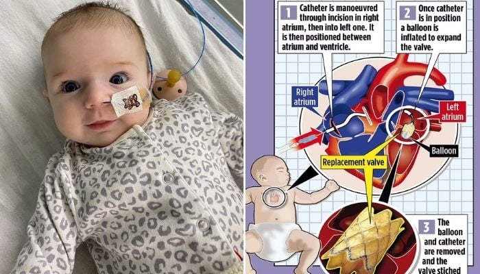 Cow tissue and metal frame save babys heart in ground-breaking surgery. —Daily Mail