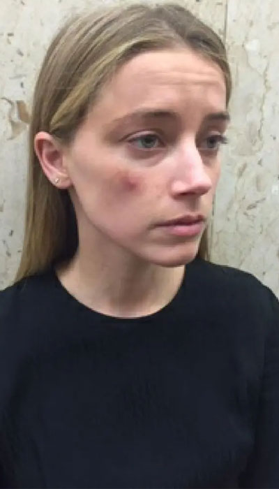 Amber Heard shows court shocking photos when Johnny Depp hit her with a phone