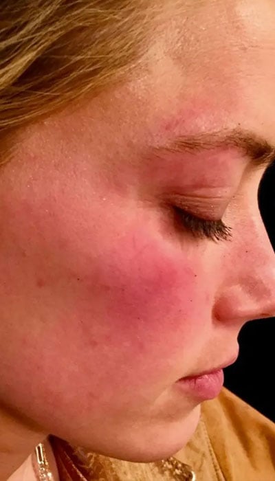 Amber Heard shows court shocking photos when Johnny Depp hit her with a phone