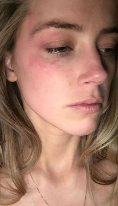 Amber Heard shows court shocking photos when Johnny Depp hit her with a phone