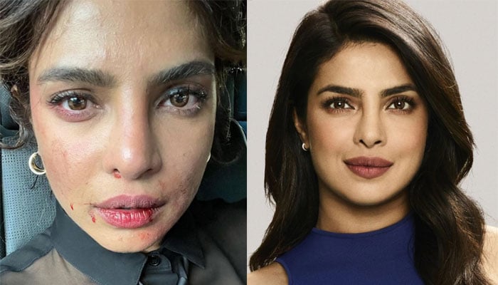 Priyanka Chopra shares a picture of her bruised face: ‘Tough day at work’