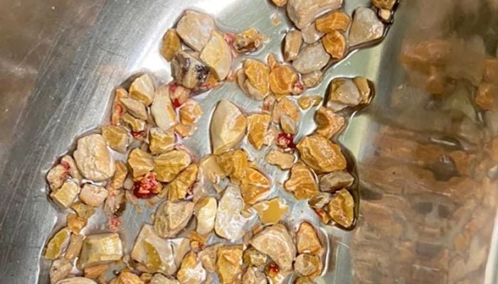 Doctors in Hyderabad, India, removed 206 kidney stones from a 56-year-old man in an hour-long operation.— NDTV