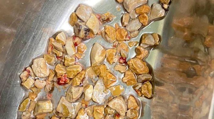 Indian doctors remove 206 kidney stones from man's body in one hour
