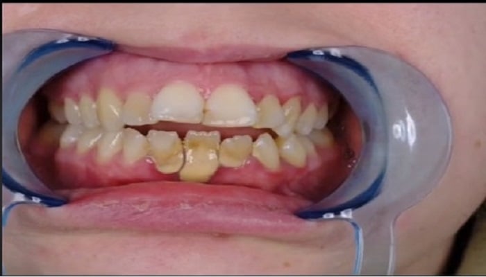 دیکھیں: عورت گھوڑے کے نئے دانتوں کی وجہ سے ٹرول ہو جاتی ہے۔