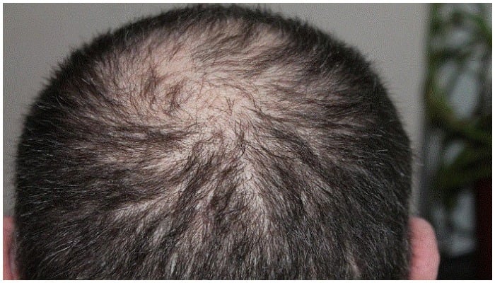 Alopecia is an autoimmune disease where the immune system attacks the hair follicles. — Pixabay/@kalhh