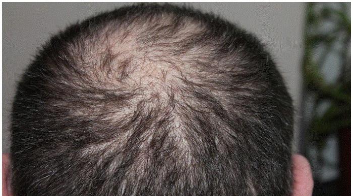 This new drug could cure baldness: study